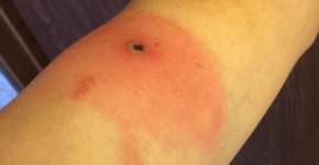 Foto: (divulgação/Departamento de Saúde do Alasca)