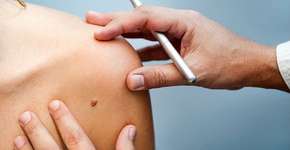 Terapia usada em cães pode ser passo para cura de câncer de pele