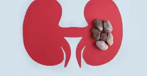 Consumo destes alimentos aumenta risco de pedra nos rins