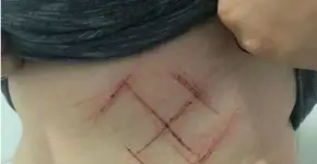 Mulher tem suástica marcada com canivete por usar camisa #EleNão