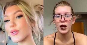 Mulher sofre efeito devastador nos lábios por causa da covid-19