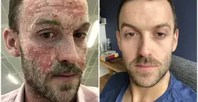 Britânico diz que curou eczema ao tomar apenas um banho por semana