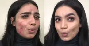 Blogueira surta ao encontrar base ‘mágica’ que esconde espinhas