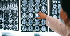 Hábito simples que pode reduzir risco de AVC em até 44 %