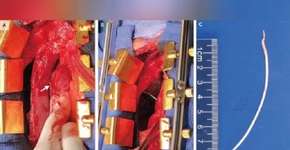 Médicos encontram pedaço de cimento no coração de paciente