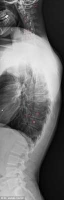 Espinhas dorsais completamente curvadas que resultam em problemas graves de coluna e para o pescoço é a principal consequência da tecnologia para a saúde da nova geração (Reprodução/The Daily Mail) 