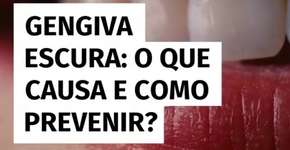 Gengiva escura: o que causa e como prevenir