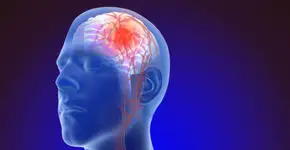 Estes são os sintomas de aneurisma cerebral