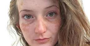 Modelo com vitiligo dá um basta no preconceito em ensaio nu