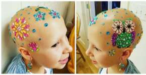 Careca brilhante: menina com doença autoimune cria novo visual