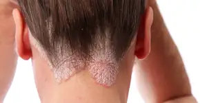 Estudo descobre alimento que pode agravar as crises de psoríase