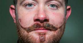 Jovem que fez tatuagem de henna pode ter cicatriz permanente