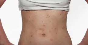 Lesões avermelhadas na pele podem ser Psoríase. Saiba mais e tire suas dúvidas online