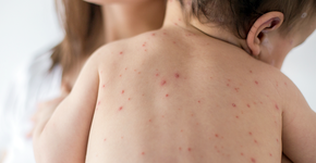 Aumento de casos de sarampo acende alerta em São Paulo