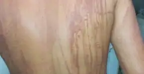 Turista fica com manchas no corpo após banho de mar em Ilhéus (BA)