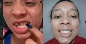 Trans que teve dente quebrado por homem ganha reconstrução