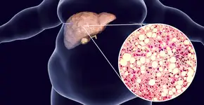 Conheça qual é o melhor chá para eliminar gordura no fígado