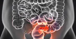 Saiba qual relação a cor das suas fezes tem com câncer no intestino