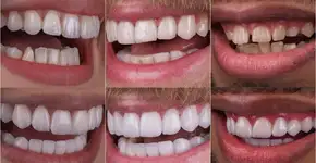 Quanto custa e como é feita a harmonização do sorriso?