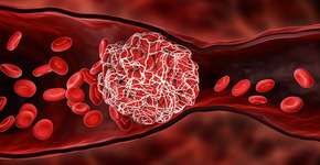 Casos de trombose venosa aumentam no país; veja como evitar