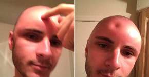 Jovem fica com a testa amassada após tomar banho de sol