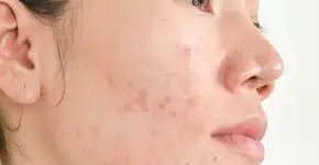 Cicatrizes de acne? Conheça os melhores tratamentos para recuperar sua pele
