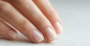 O que significa ter unhas listradas?