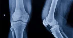 9 alimentos que fazem bem para os ossos (e um que nem tanto)