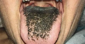 Manchas, cor e textura da língua que dizem muito sobre sua saúde