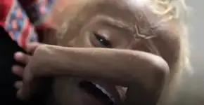 Garoto cuja imagem chocou mundo recebe tratamento pra desnutrição