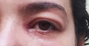 Blefarite: conheça o desconforto nos olhos que afeta mais as mulheres e como evitar