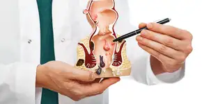 Conheça os sintomas do câncer de ânus e as causas da doença