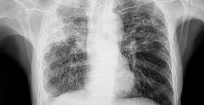 Estes são os sintomas de tuberculose para você ficar atento