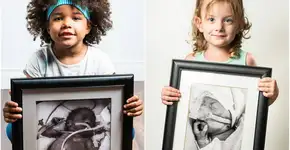 Imagens mostram bebês prematuros no começo de suas vidas e depois