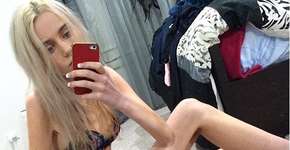 Jovem com anorexia vira vegana e passa por transformação incrível