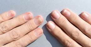 5 sinais nas unhas pouco conhecidos que podem indicar câncer