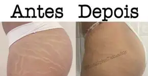 Tatuador que camufla estrias faz sucesso entre as famosas