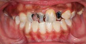 Cuidado: cárie também pode ser ‘transmitida’. Saiba como prevenir