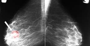 Os 8 fatores que colocam você em maior risco de câncer de mama