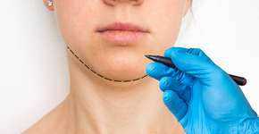 Papada: mitos e verdades na prevenção e redução