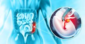 Câncer de cólon em jovens: saiba o principal fator de risco e como se proteger