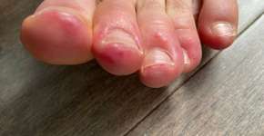 Lesões nos pés: entenda por que a covid-19 pode causar o problema