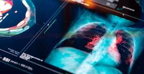 Novo medicamento contra câncer de pulmão reduz risco de morte em 51%