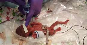 Bebê que nasceu com 245 gramas recebe alta do hospital