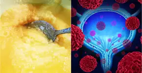 Comer em excesso esse tipo de gordura aumenta o risco de câncer de bexiga em homens