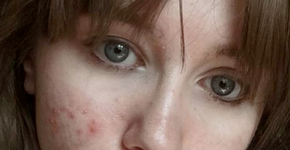 Jovem posta selfie para mostrar que é bonita mesmo com acne