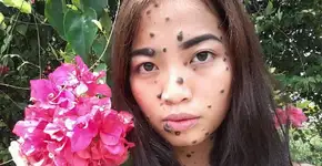 Jovem malaia mostra como passou a aceitar as suas pintas