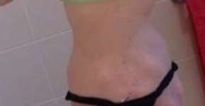 Modelo anoréxica que chegou a pesar 37 quilos se recupera e participa de concurso