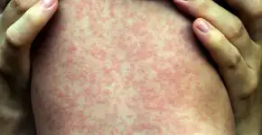 São Paulo tem mais duas mortes por sarampo
