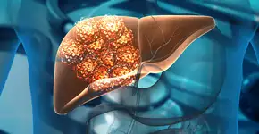 Novo estudo diz que esta bebida pode aumentar risco de câncer de fígado